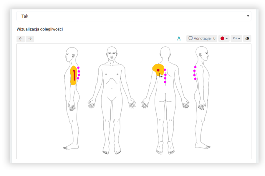 Podgląd oznaczonych miejsc bólu